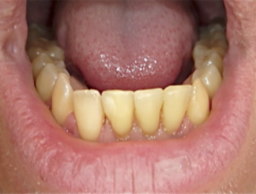 Provisorisk tandprotese undermund